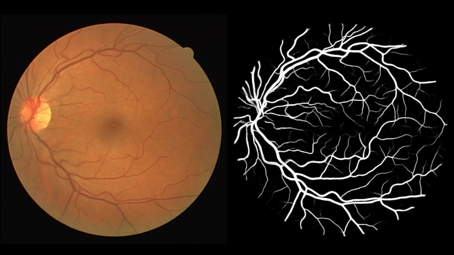 Искусственный интеллект ускорит постановку диагноза по снимку сетчатки глаза